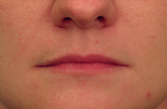 Restylane for lip augmentation before 82764
