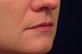 Restylane for lip augmentation 82764