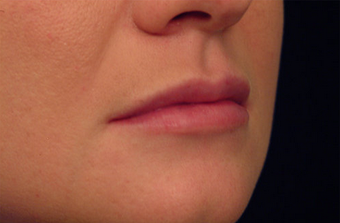 Restylane for lip augmentation 82764