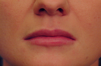 Restylane for lip augmentation after 82764