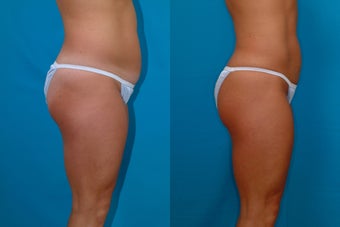 32-year-old woman treated with Liposuction. after 341944