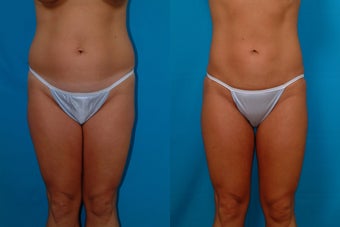 32-year-old woman treated with Liposuction. before 341944