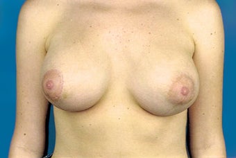 Breast implant removal and replacement with breast lift after 174824