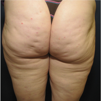 55-64 year old woman treated with Cellulaze before 3142716