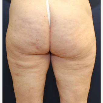 55-64 year old woman treated with Cellulaze after 3142716