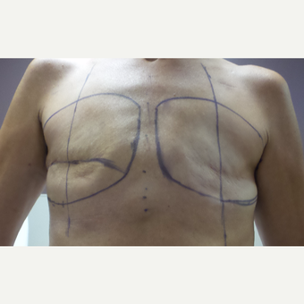 45-54 year old woman treated with Breast Reconstruction before 3196048
