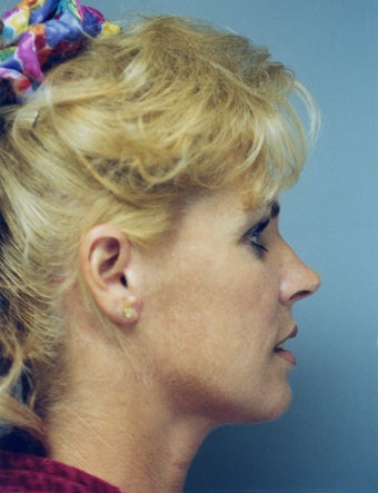 42-year old Neck Lift and Lower Facelift after 1222989