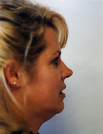 42-year old Neck Lift and Lower Facelift before 1222989