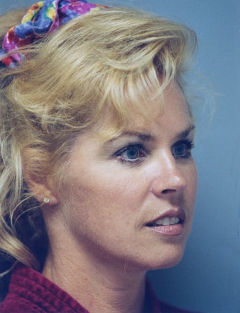 42-year old Neck Lift and Lower Facelift 1222989