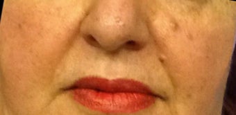 45-54 year old woman treated with Restylane Lyft before 3482126