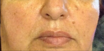 45-54 year old woman treated with Restylane Lyft after 3482126