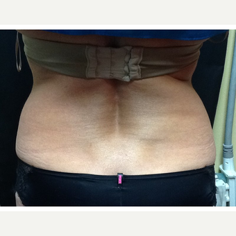 45-54 year old woman treated with CoolSculpting after 3702772