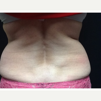 45-54 year old woman treated with CoolSculpting before 3702772