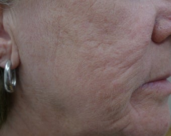 Results with one Fractional Treatment after 1424002