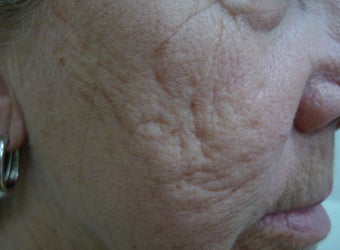 Results with one Fractional Treatment before 1424002