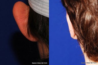 Ear Surgery before 1445739