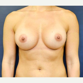 25-34 year old woman treated with Breast Augmentation after 2270428