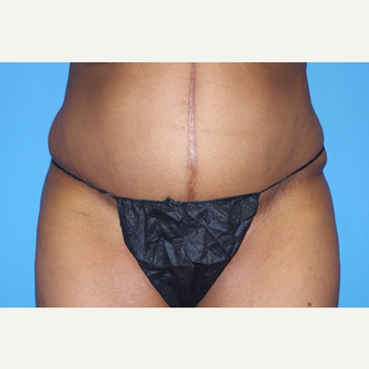 45-54 year old woman treated with Panniculectomy; 15 months post-op after 2735604