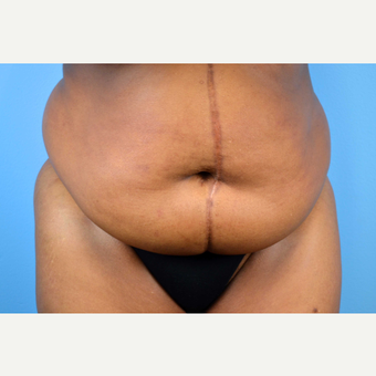 45-54 year old woman treated with Panniculectomy; 15 months post-op before 2735604