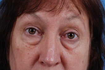 excess skin and fat upper and lower eyes before 1290773