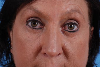 excess skin and fat upper and lower eyes after 1290773