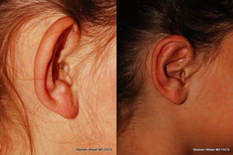 Ear Surgery before 1445752