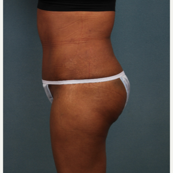 45-54 year old woman treated with Tummy Tuck after 3253778