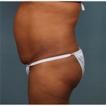 45-54 year old woman treated with Tummy Tuck before 3253778