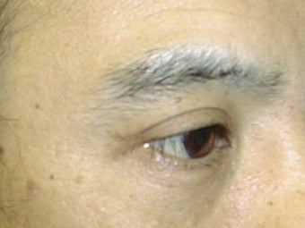 Upper Eyelid Blepharoplasty after 1007760