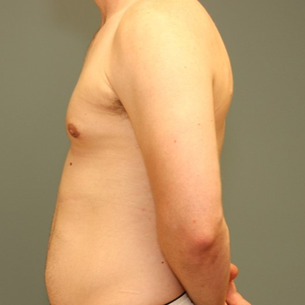 35-44 year old man requesting Male Breast Reduction after 3346445