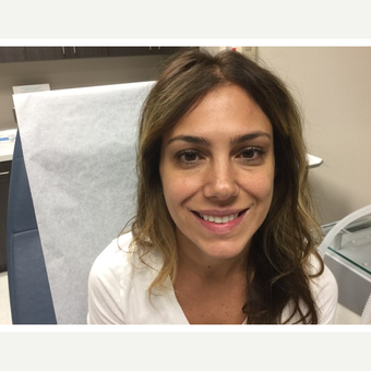 25-34 year old woman treated with Botox after 2860750