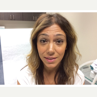 25-34 year old woman treated with Botox before 2860750