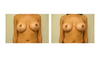 breast Revision before 983140