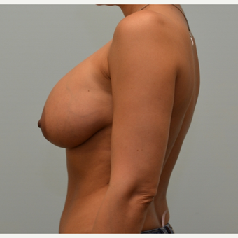 Removal of intact saline implants, insertion of smaller silicone implants, and breast lift. before 2458202