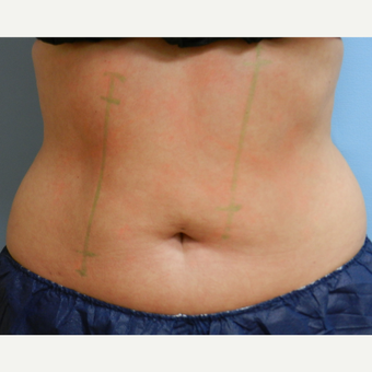 35-44 year old woman treated with CoolSculpting before 3748649