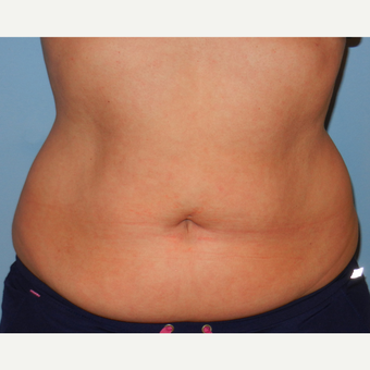 35-44 year old woman treated with CoolSculpting after 3748649