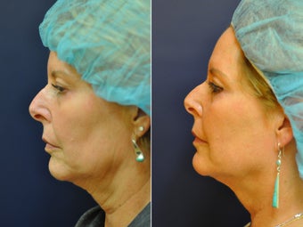 56 Year Old Female Before/After Ultherapy Full Face before 1053228