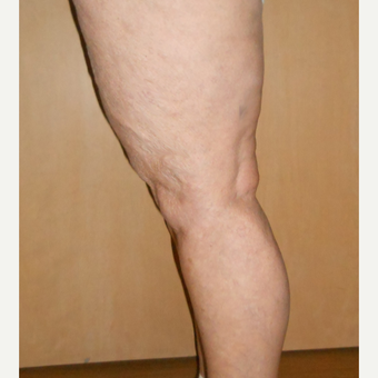 65-74 year old woman treated with Vein Treatment after 3161469