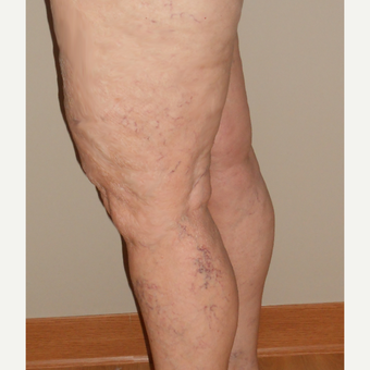 65-74 year old woman treated with Vein Treatment before 3161469