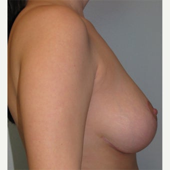 25-34 year old woman treated with Breast Reduction 1724684