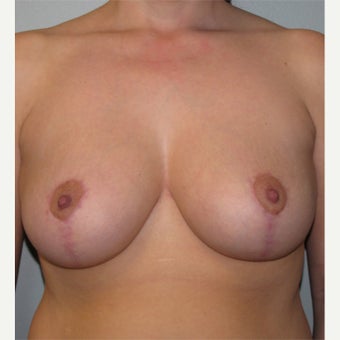25-34 year old woman treated with Breast Reduction after 1724684