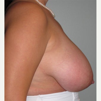 25-34 year old woman treated with Breast Reduction 1724684