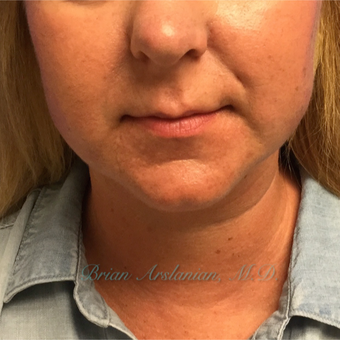 35-44 year old woman treated with Kybella for double chin reduction after 3151937
