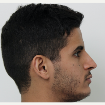 25-34 year old man treated with Revision Rhinoplasty after 3583832