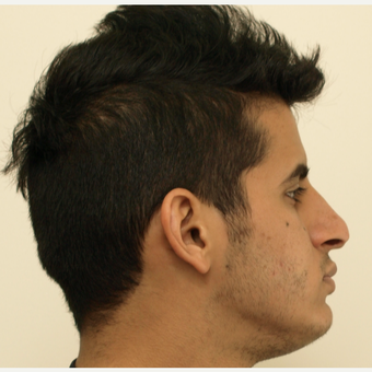 25-34 year old man treated with Revision Rhinoplasty before 3583832