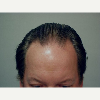 Hair Transplant before 3241375