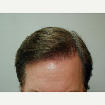 Hair Transplant after 3241375