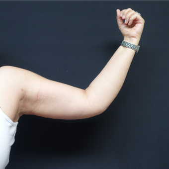 45-54 year old woman treated with Arm Lift after 3730408
