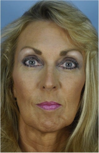49 year old woman who wanted improvement of the lower face and neck before 1287537