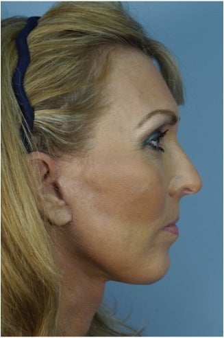 49 year old woman who wanted improvement of the lower face and neck 1287537